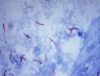 Tack: Größtmögliche Sorgfalt und Sicherheit bei aktuellen Tuberkulose-Erkrankungen in Brandenburg