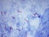 Tack: Größtmögliche Sorgfalt und Sicherheit bei aktuellen Tuberkulose-Erkrankungen in Brandenburg